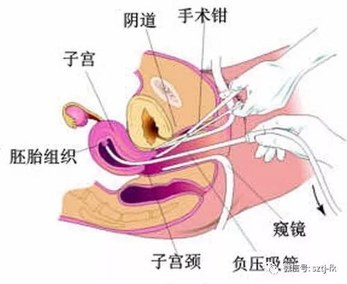 两个月妊娠与无痛人流，了解怀孕早期终止妊娠的选择