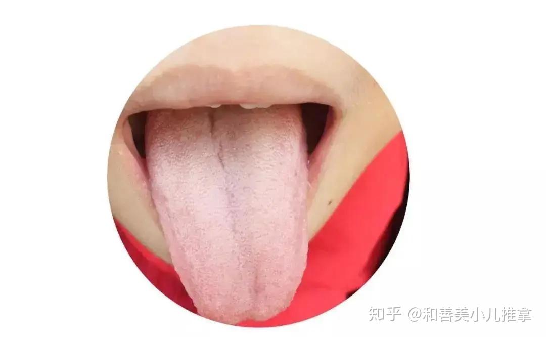 两个月婴儿舌苔厚白的原因解析