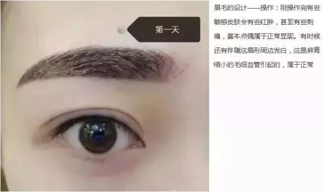 纹眉几个月后痒，原因解析与应对方法