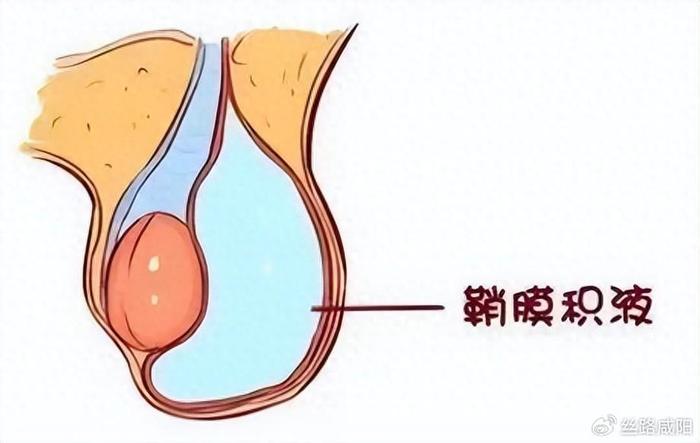 两个月宝宝睾丸积液，了解、关注与应对