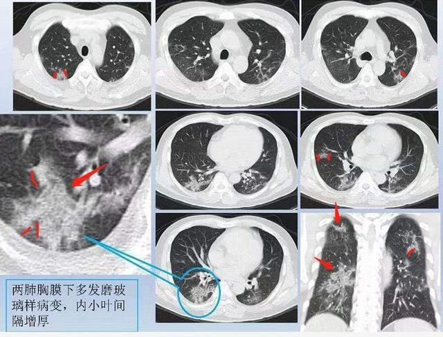 肺炎新型最新