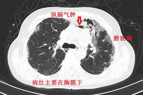 相关肺炎最新