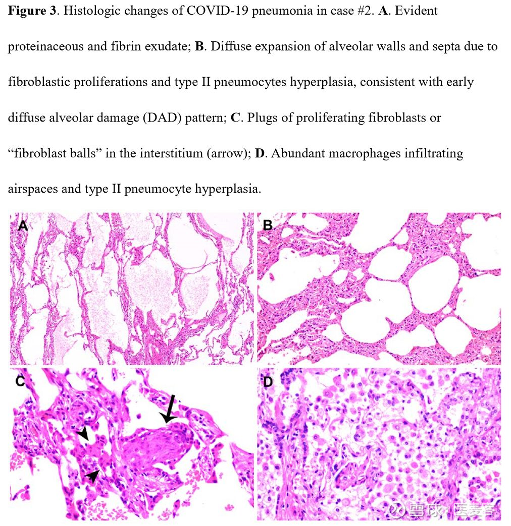 肺炎最新病理